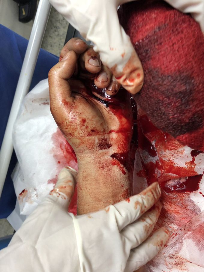 Injure of Cubital Artery