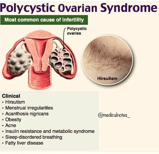 Pcos/pcod