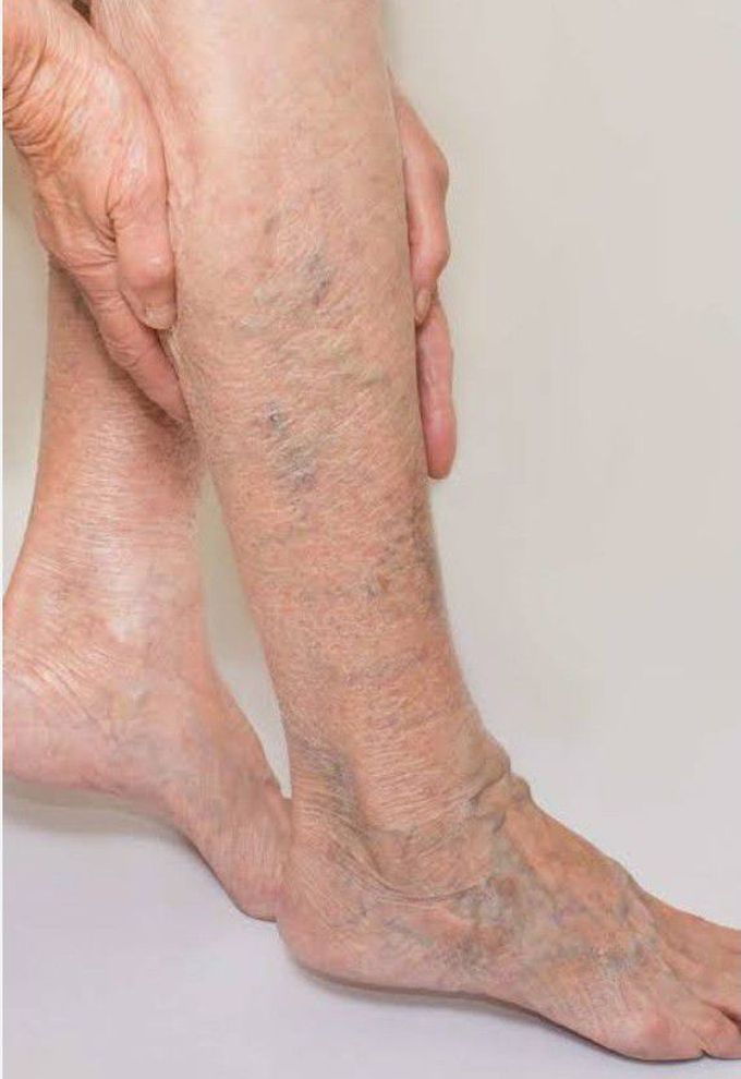 Symptoms of Varicose veins