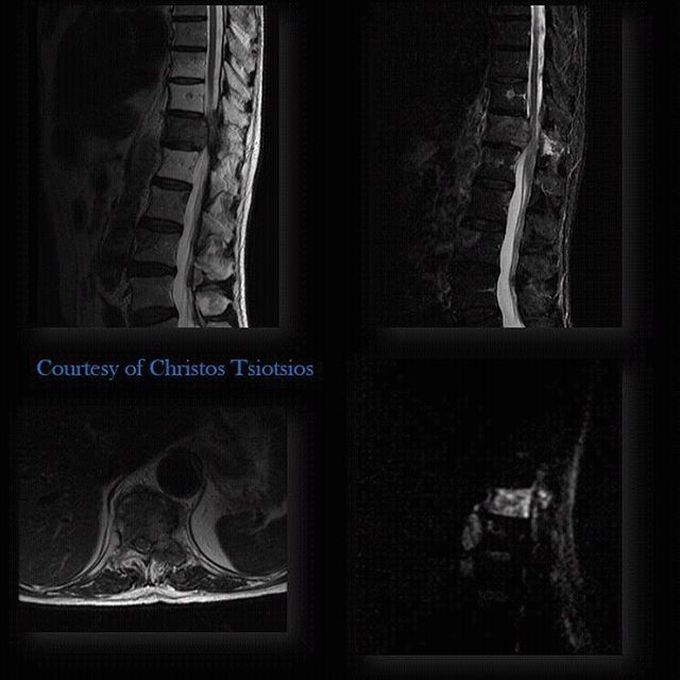 Patient with vertebral metastasis