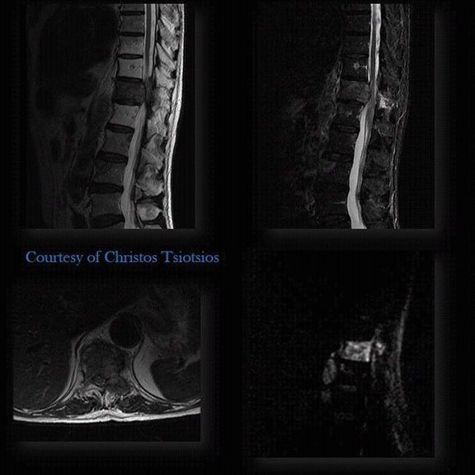 Patient with vertebral metastasis