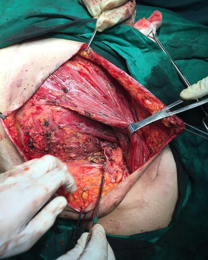 Nerves preserving in modified radical mastectomy...
