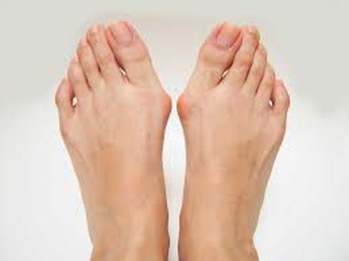 Bunions (Hallux Valgus)