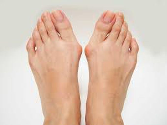 Bunions (Hallux Valgus)