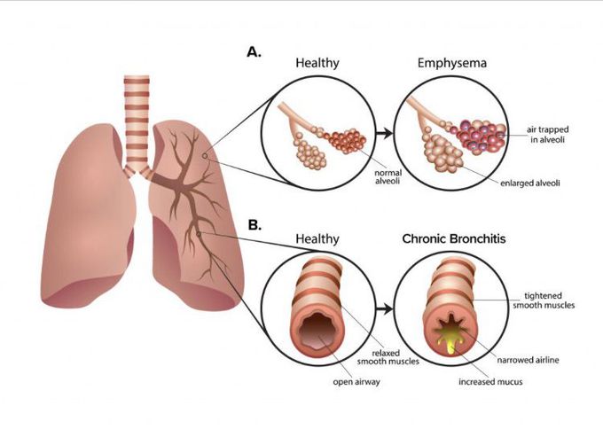 Chronic obstructive pulmonary disease (COPD) includes one or more of three separate diseases:

Emphysema
Chronic bronchitis
Chronic obstructive asthma
They all make it harder to breathe and get worse over time.

The three key symptoms of COPD are:

Shortness of breath
A cough that doesn’t go away
Coughing up thick, often colored mucus (phlegm