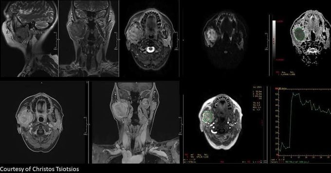 Multiparametric (anatomical, functional and quantitative) head &amp; neck MRI in a patient with solitary plasmacytoma of the mandible