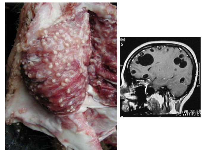 Taenia solium taeniasis/cysticercosis