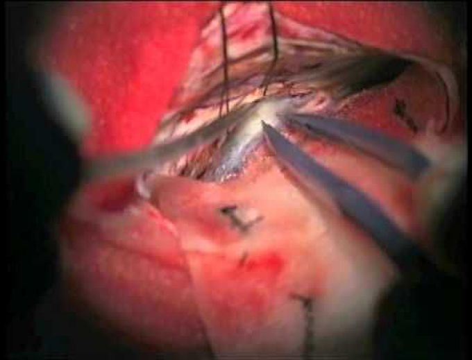 Retractorless surgery for a pineal region tumor through an occipital transtentorial approach