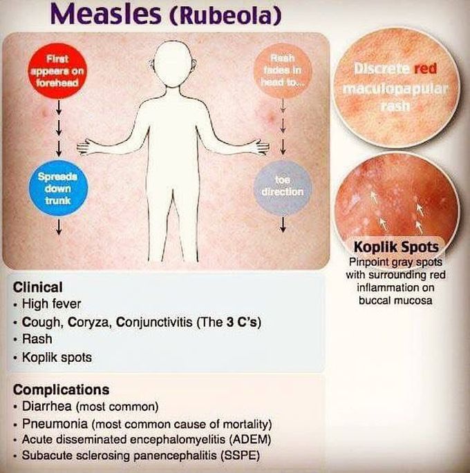 Measles