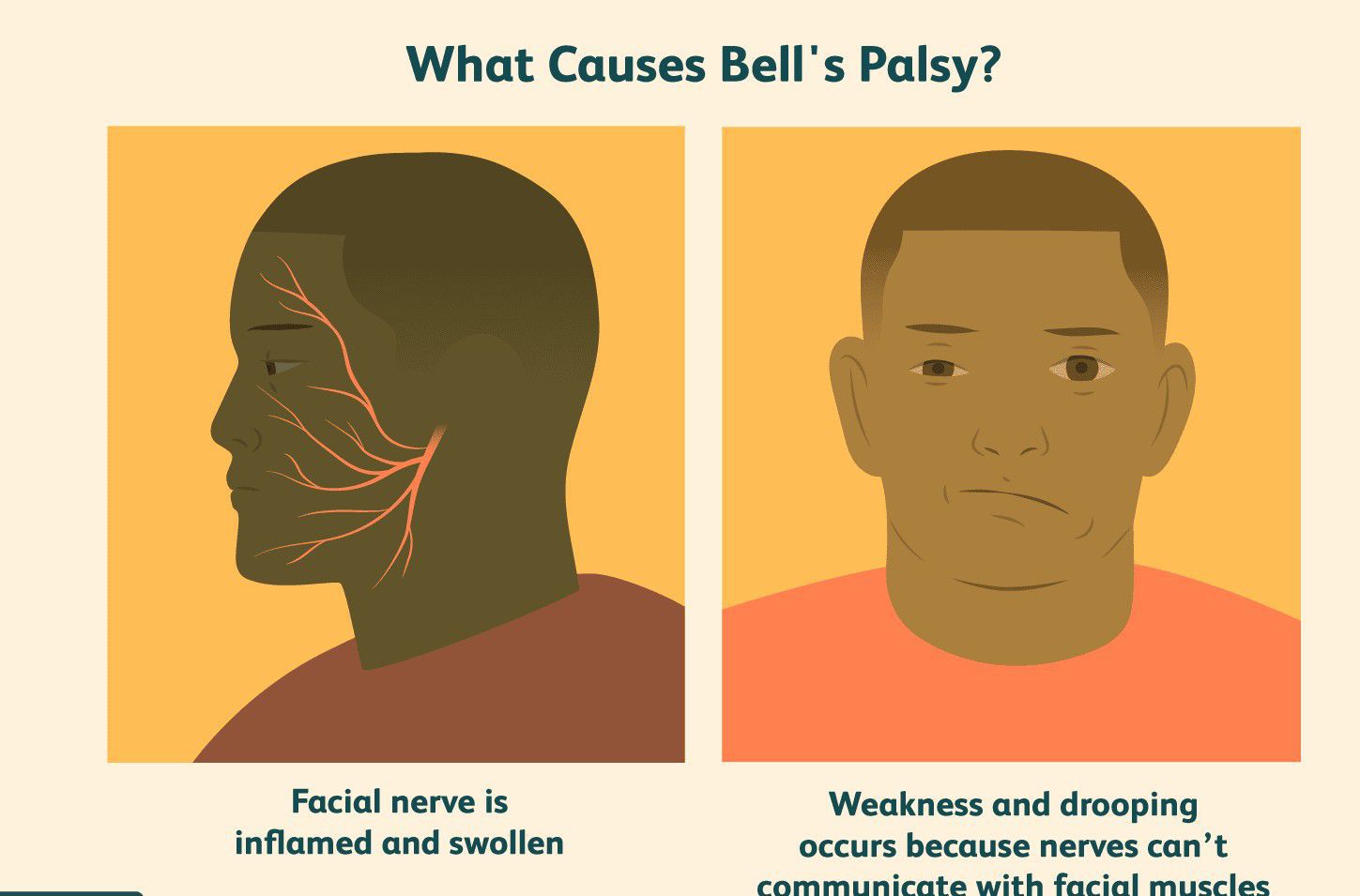 Causes of Bell's Palsy - MEDizzy