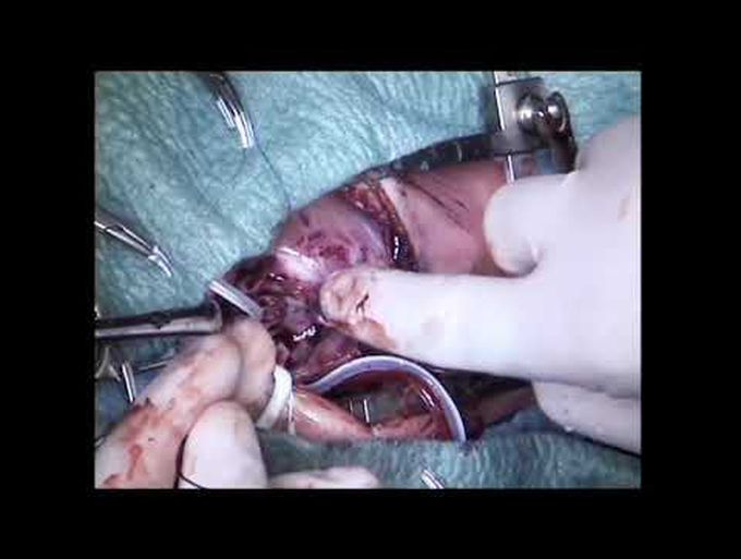 Hemitruncus Repair