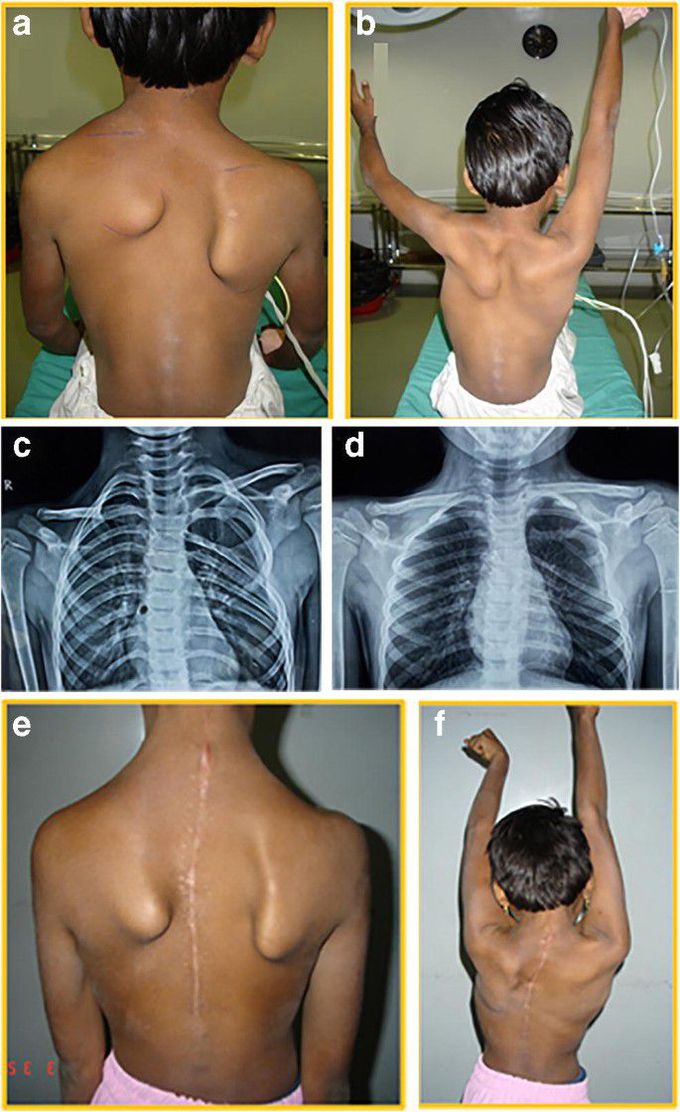 Sprengel Shoulder