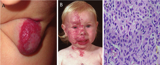 Hemangioma