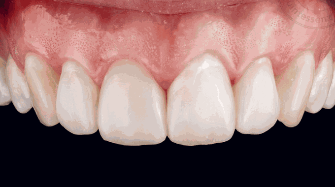 What are anterior teeth?