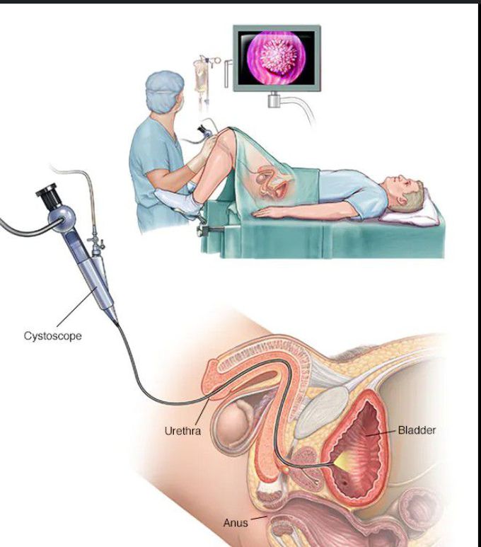 Treatment for Hematuria