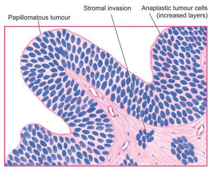 Transitional cell carcinoma