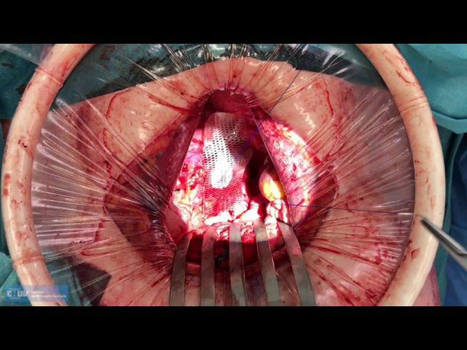 Perineal Hernia Repair