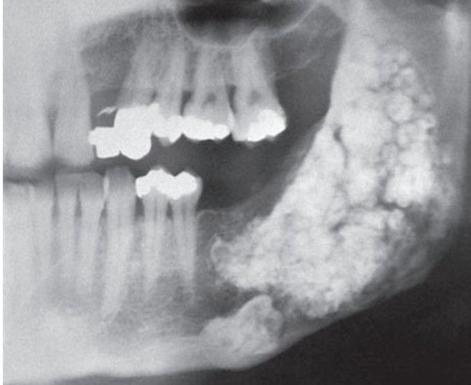 Odontoma