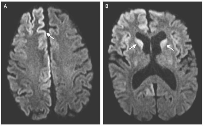 Creutzfeldt–Jakob Disease