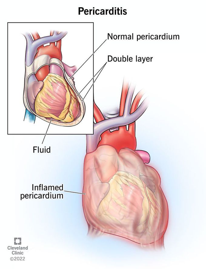 Pericarditis