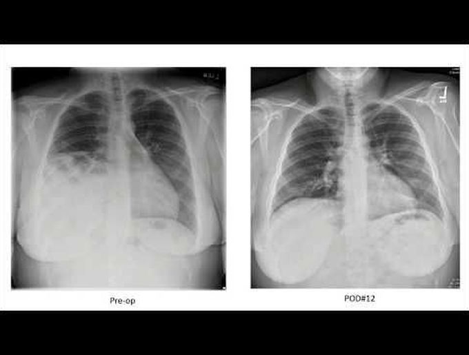 Robotic Repair of Hernia of Morgagni