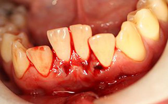 Lateral Luxation