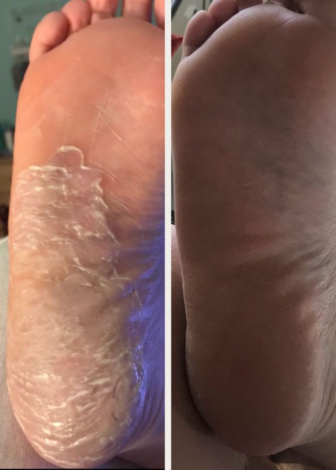 Before and after treatment for an unknown disorder!