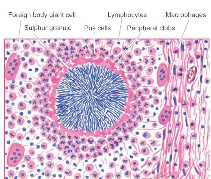 Actinomycosis