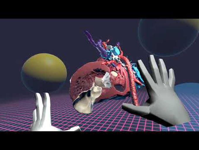 Common Arterial Trunk and Complete Atrioventricular Septal Defect Repair