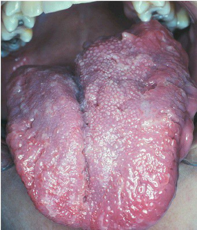 Neurofibromatosis Type I.