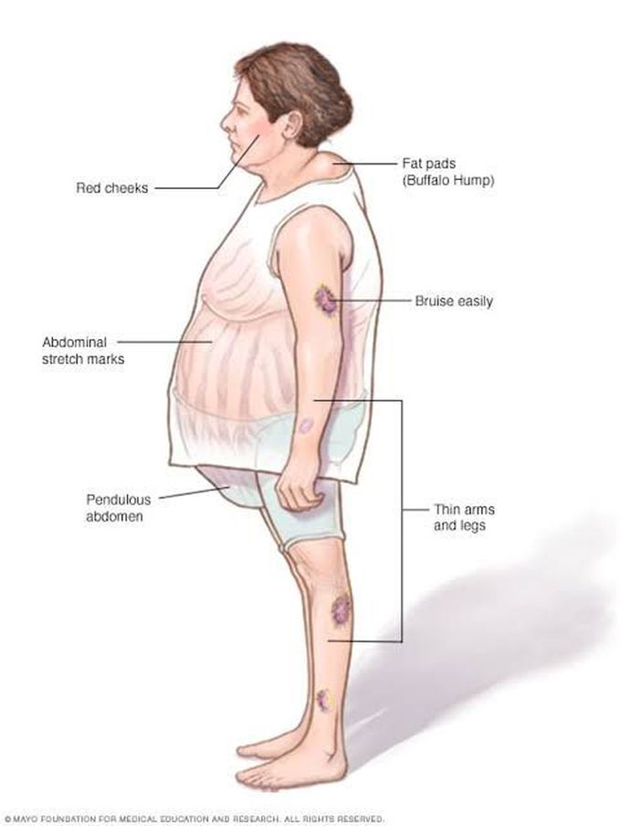 Cushing's syndrome