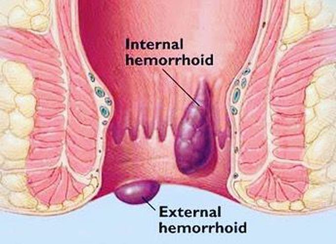 Piles or Hemorrhoids