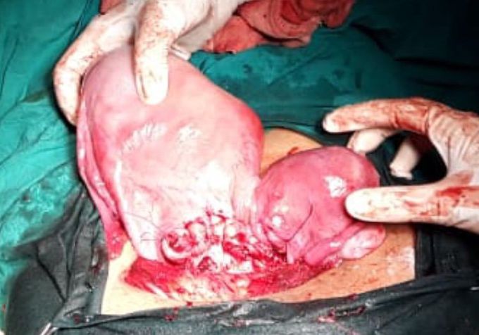 Caesarean section