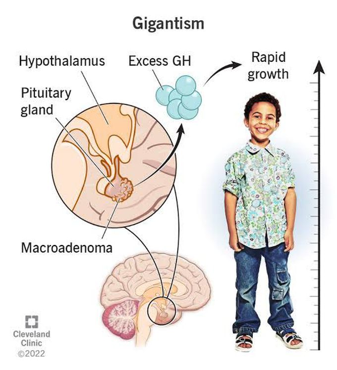 Gigantism Medizzy