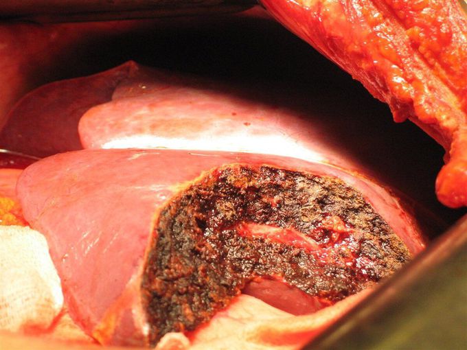 Hepatic resection..