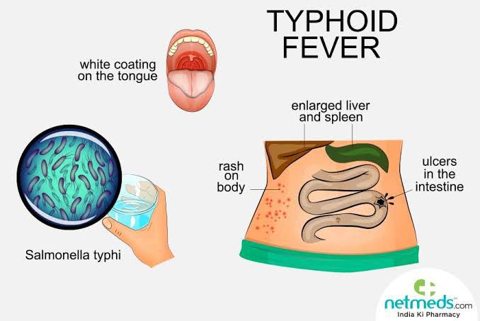 Typhoid - MEDizzy