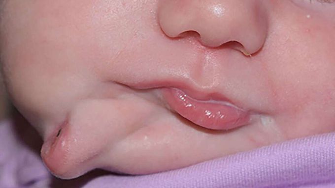 Baby born with two mouths!