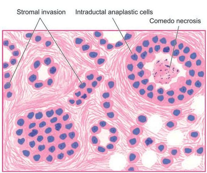 Infiltrating duct carcinoma-NOS