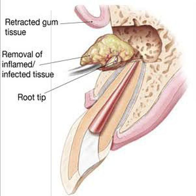 Apisectomy