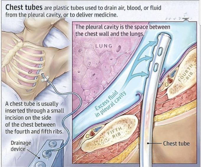 Chest tube incision