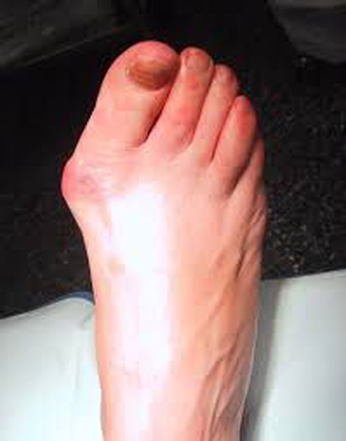 signs of bunions
