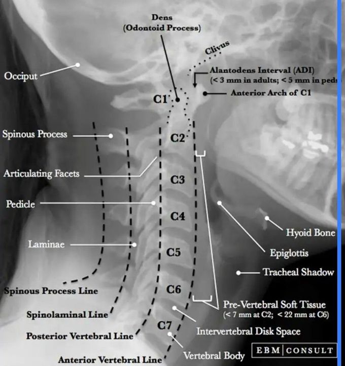 Cervical Vertebrae