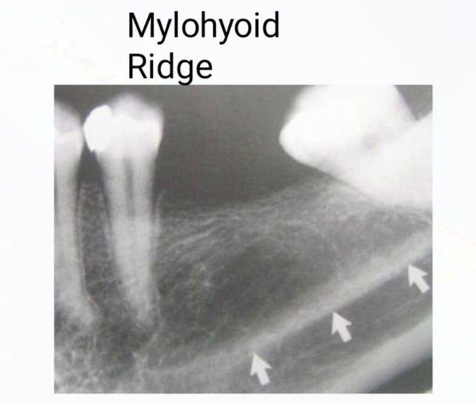 Mylohyoid Ridge