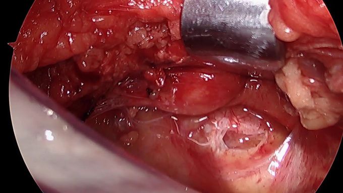 Subxiphoid Pericardial Window: Steps and Helpful Tips