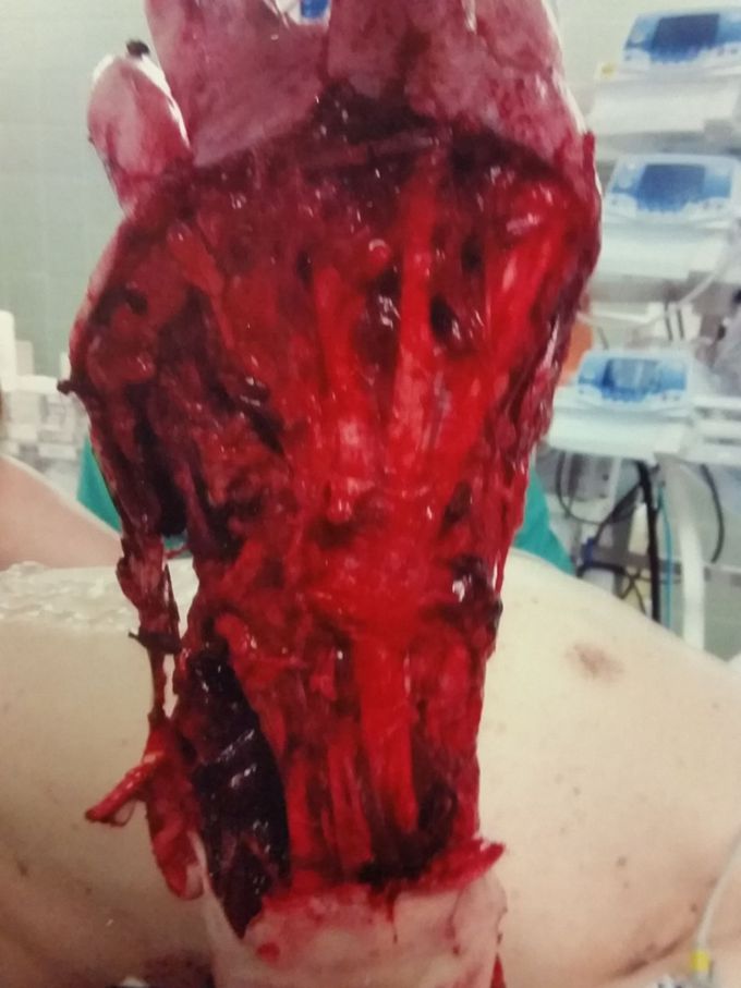 Car Accident with the arm out of the window