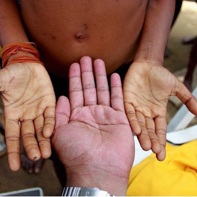 Anemia due to chronic Malaria