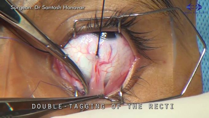 Enucleation - Eye Removal Surgery