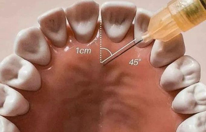 Nasopalatine Nerve Block