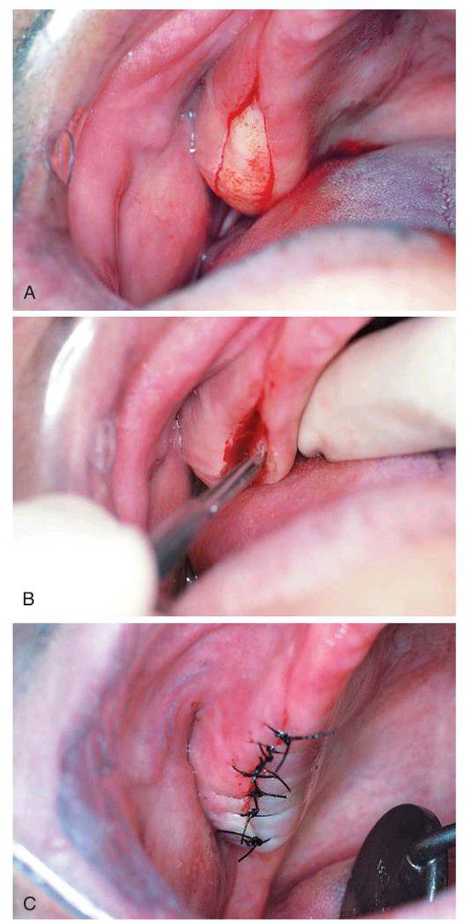 Maxillary soft tissue tuberosity reduction