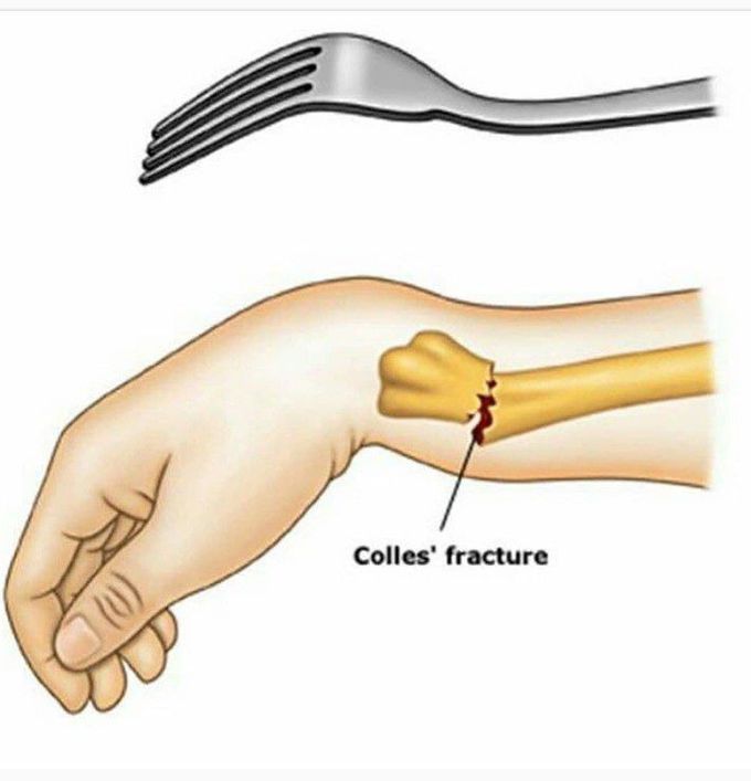 Colle's Fracture